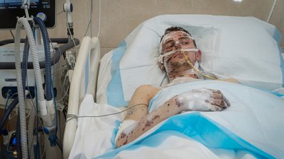 "Вижив, бо витягли побратими". Військового з численними пораненнями лікують на Дніпропетровщині "Вижив, бо витягли побратими". Військового з численними пораненнями лікують на Дніпропетровщині