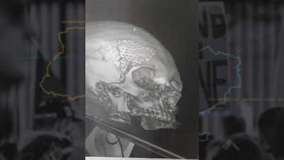 Отвір у черепі Людмили закрили титановою пластиною Отвір у черепі Людмили закрили титановою пластиною