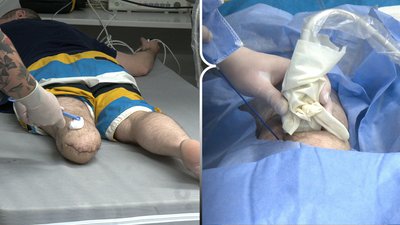 Операцію, яка допомагає полегшити фантомний біль після ампутацій, проводять у Рівному