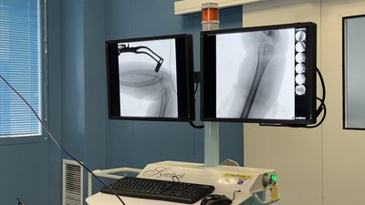 У Львові хірурги прооперували дитину з рідкісним зрощенням кісток передпліччя У Львові хірурги прооперували дитину з рідкісним зрощенням кісток передпліччя