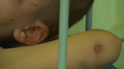 Луцькі лікарі прокоментували стан дітей, яких побив батько. Хлопчик у важкому стані Луцькі лікарі прокоментували стан дітей, яких побив батько. Хлопчик у важкому стані