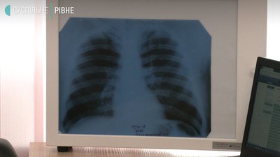 Перевірка на туберкульоз: де це зробити у Рівному та чому це важливо