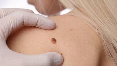 На Львівщині від початку року зафіксували 130 випадків меланоми шкіри