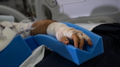 Пожежа на Чернігівщині: чоловік зазнав опіків і його госпіталізували