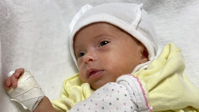 Львівські хірурги сформували кишківник новонародженій дитині