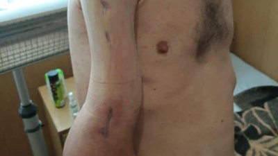 У звільненого з полону бійця з Тернополя роздроблена права рука У звільненого з полону бійця з Тернополя роздроблена права рука