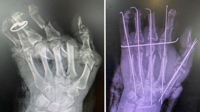 Рука до та після операції Рука до та після операції