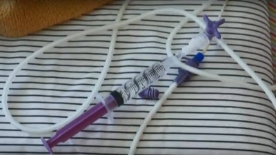 Важкохворі діти на Львівщині можуть залишитися без спеціального харчування
