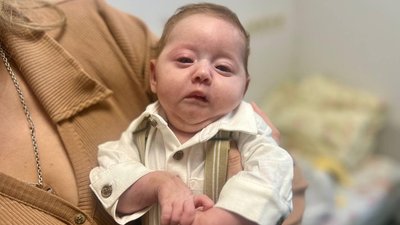У львівському "Охматдиті" прооперували немовля із рідкісною вадою