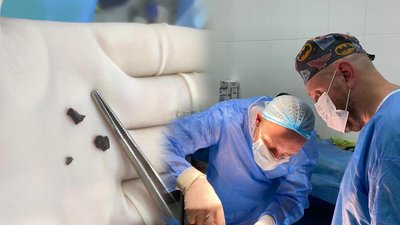 Поранена під час обстрілу Харкова 20 липня 15-річна дівчина залишається в реанімації