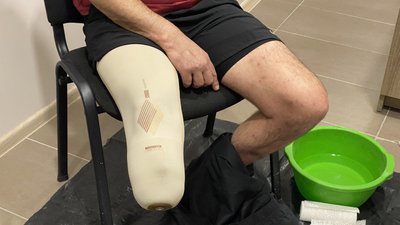 У полтавському медцентрі безкоштовно протезують цивільних та військовослужбовців У полтавському медцентрі безкоштовно протезують цивільних та військовослужбовців