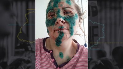 Два роки після обстрілу центра Харкова: як відновлюються поранені аптекарки Два роки після обстрілу центра Харкова: як відновлюються поранені аптекарки