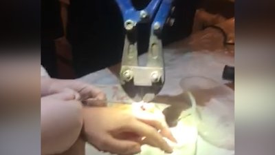 Рятувальники на Житомирщині знімали з пальця 14-річного хлопця металевий підшипник Рятувальники на Житомирщині знімали з пальця 14-річного хлопця металевий підшипник