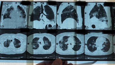"Не шкодуйте кисню хворим". COVID-19 у цитатах та фото від волинського лікаря "Не шкодуйте кисню хворим". COVID-19 у цитатах та фото від волинського лікаря