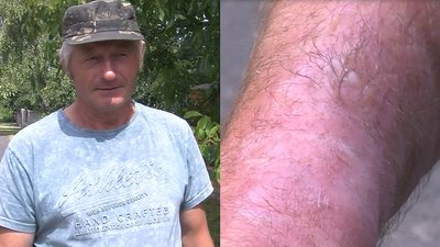 Двоє вже попеклися: на Волині борються з борщівником Двоє вже попеклися: на Волині борються з борщівником