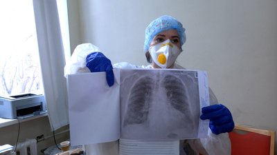 За три дні – тотальне ураження: як виглядають рентгенівські знімки легенів пацієнтів з COVID-19 За три дні – тотальне ураження: як виглядають рентгенівські знімки легенів пацієнтів з COVID-19