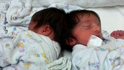 В Ізраїлі вперше змогли розділити сіамських близнюків