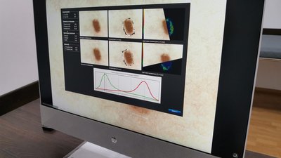 У Чернівецький обласний онкологічного центру придбали дерматоскоп У Чернівецький обласний онкологічного центру придбали дерматоскоп