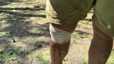 Перев'язана нога травмованого внаслідок обстрілів чоловіка, 6 липня 2025 року, Миколаїв Перев'язана нога травмованого внаслідок обстрілів чоловіка, 6 липня 2025 року, Миколаїв