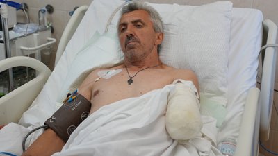 поранений, ампутація