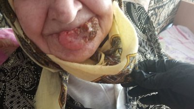Одна із пацієнток будинку-інтернату уже два роки страждає від пухлини на обличчі. Фото: представництво Офісу уповноваженого ВРУ з прав людини в Хмельницькій області. Одна із пацієнток будинку-інтернату уже два роки страждає від пухлини на обличчі. Фото: представництво Офісу уповноваженого ВРУ з прав людини в Хмельницькій області.