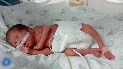 У перинатальному центрі виходили дитину з вагою 600 грамів