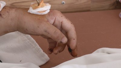 Мріє зійти на Говерлу. Історія мінометника з Дніпра, який лікується в Івано-Франківську Мріє зійти на Говерлу. Історія мінометника з Дніпра, який лікується в Івано-Франківську