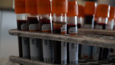 У Хмельницькому інсулінозалежним пацієнтам безкоштовно робитимуть тест на гемоглобін