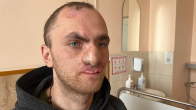 Валентин Ковальов після п'ятої операції, поранння в обличчя, реконструкція носа