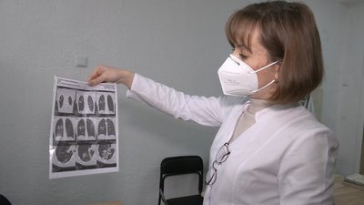 У Харківській області у півтора раза зросла кількість захворювань на туберкульоз, у Харкові — майже вдвічі