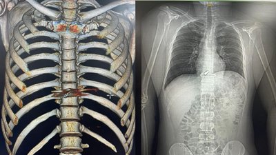 Дві доби йшов з-під Роботиного з кулею у серці: історія військовослужбовця на позивний Туз Дві доби йшов з-під Роботиного з кулею у серці: історія військовослужбовця на позивний Туз