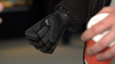 У Львові у реабілітаційному центрі встановили біонічний протез руки бойовому медику У Львові у реабілітаційному центрі встановили біонічний протез руки бойовому медику
