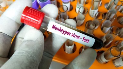 Мавпяча віспа: що це за хвороба та чи може вона з’явитися в Україні