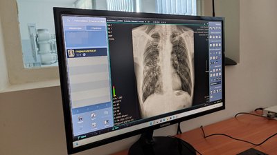 "Відчував, що худну": у волинському тубдиспансері зараз лікують пів сотні пацієнтів