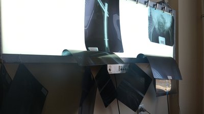 В Ужгородській міській лікарні лікують вимушених переселенців, поранених у зоні бойових дій