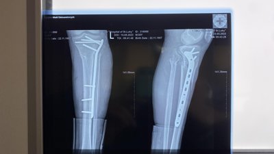 Відновлюють функцію ноги: у Львові прооперували військового з Одеси Відновлюють функцію ноги: у Львові прооперували військового з Одеси