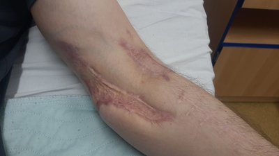 Переніс 12 операцій. Історія одужання воїна з Івано-Франківська Мар'яна Данилюка Переніс 12 операцій. Історія одужання воїна з Івано-Франківська Мар'яна Данилюка