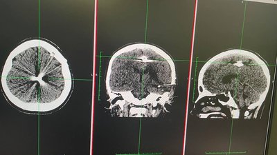 Лікарі Охматдиту дістали з голови дівчинки з Миколаївщини уламок російського снаряда Лікарі Охматдиту дістали з голови дівчинки з Миколаївщини уламок російського снаряда