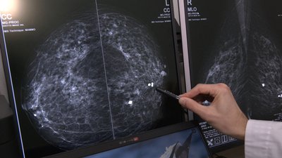 мамографія, рак грудей, онкологія, онкодиспансер, тернопіль
