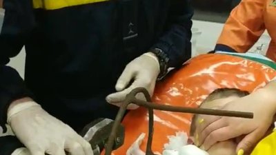 Народився у сорочці: у Полтаві з шиї дитини дістали шматок арматури Народився у сорочці: у Полтаві з шиї дитини дістали шматок арматури