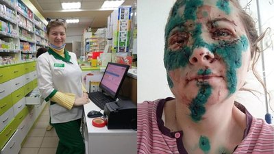 Харківська фармацевтка отримала тяжке поранення обличчя внаслідок обстрілу РФ