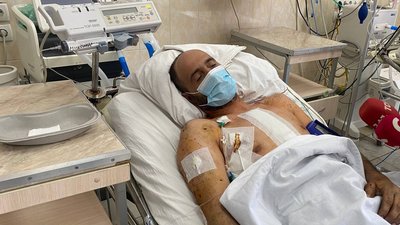 "Зупинили серце, аби дістати уламок": в одній з лікарень Дніпра прооперували військовослужбовця "Зупинили серце, аби дістати уламок": в одній з лікарень Дніпра прооперували військовослужбовця