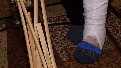 Жінка на Сумщині після аварії опинилась вдома з непоміченим переломом ноги Жінка на Сумщині після аварії опинилась вдома з непоміченим переломом ноги