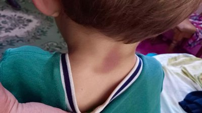 На Івано-Франківщині побили 6-річного хлопчика — дитина в лікарні На Івано-Франківщині побили 6-річного хлопчика — дитина в лікарні