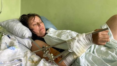 Пересадили м'яз зі спини: у Львові хірурги врятували ногу жінці з Бахмута