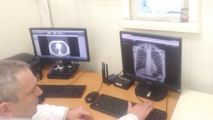 Як штучний інтелект допомагає лікарям-рентгенологам діагностувати туберкульоз у Сумах