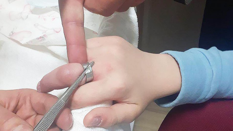 У Львові рятувальники зняли каблучку з пальця дитини за допомогою обладнання